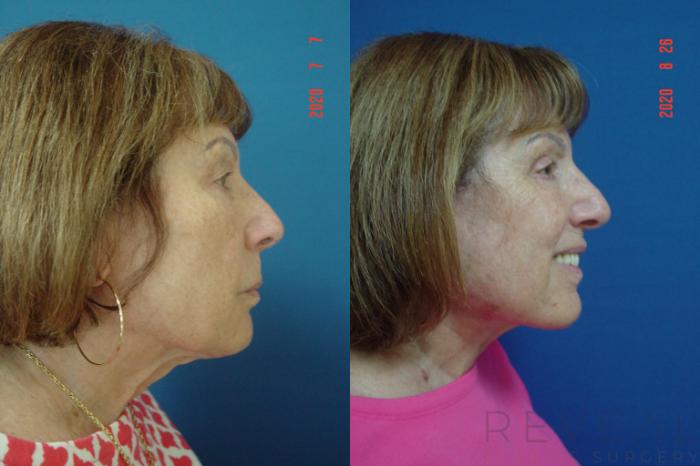 Before & After Eyelid Surgery Case 415 View #2 View in San Jose, CA