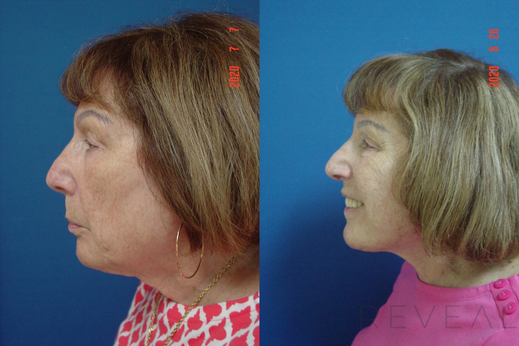 Before & After Facelift Case 415 View #3 View in San Jose, CA