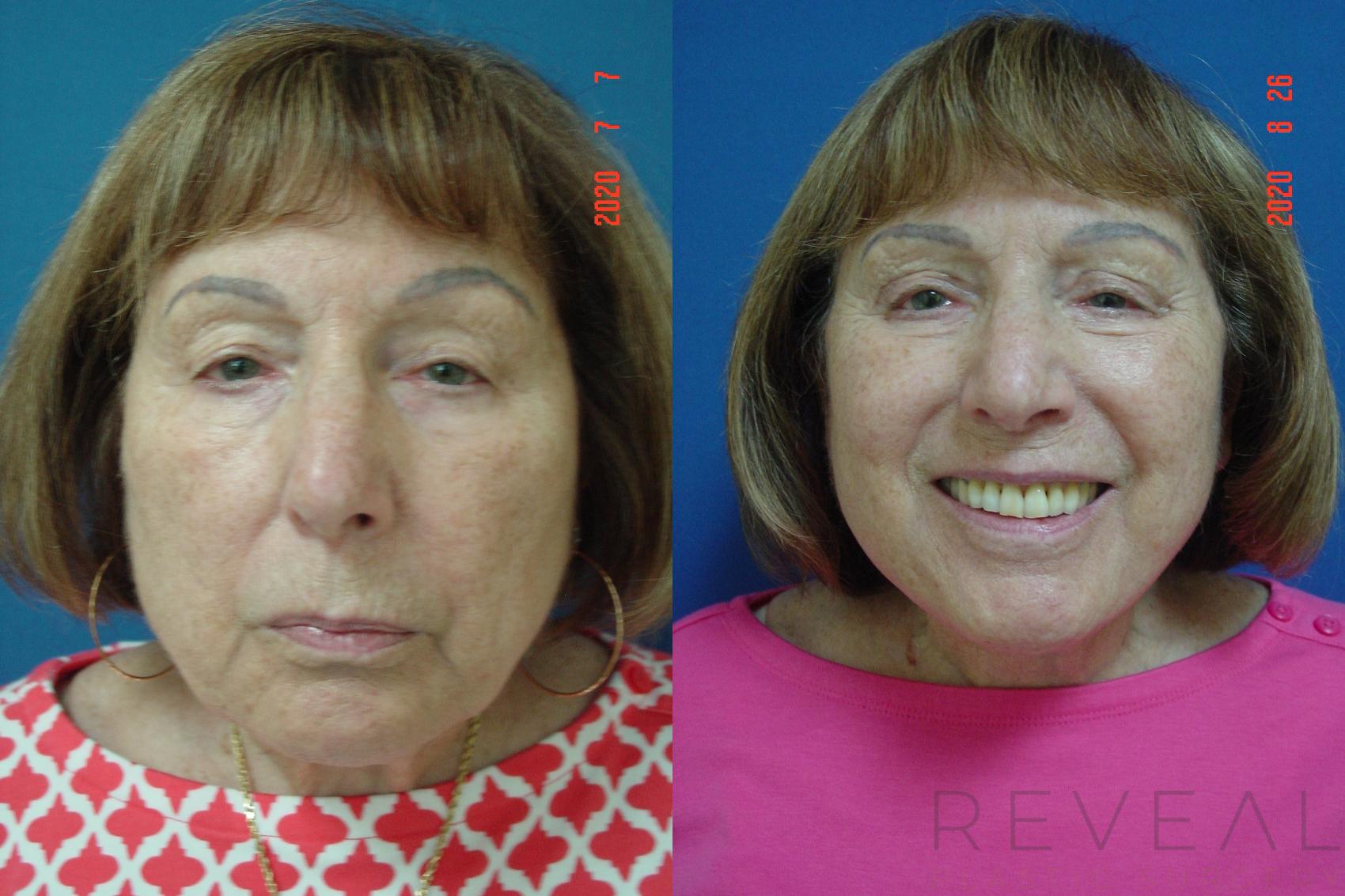 Before & After Facelift Case 415 View #4 View in San Jose, CA