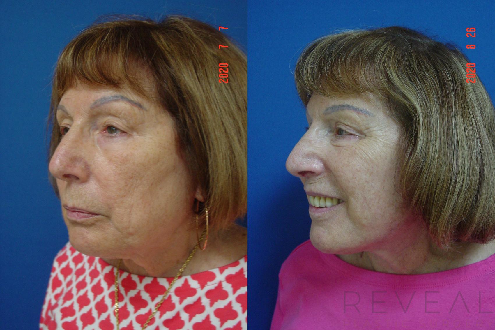 Before & After Facelift Case 415 View #5 View in San Jose, CA
