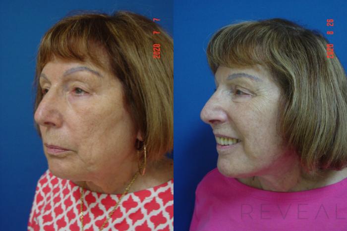 Before & After Eyelid Surgery Case 415 View #5 View in San Jose, CA