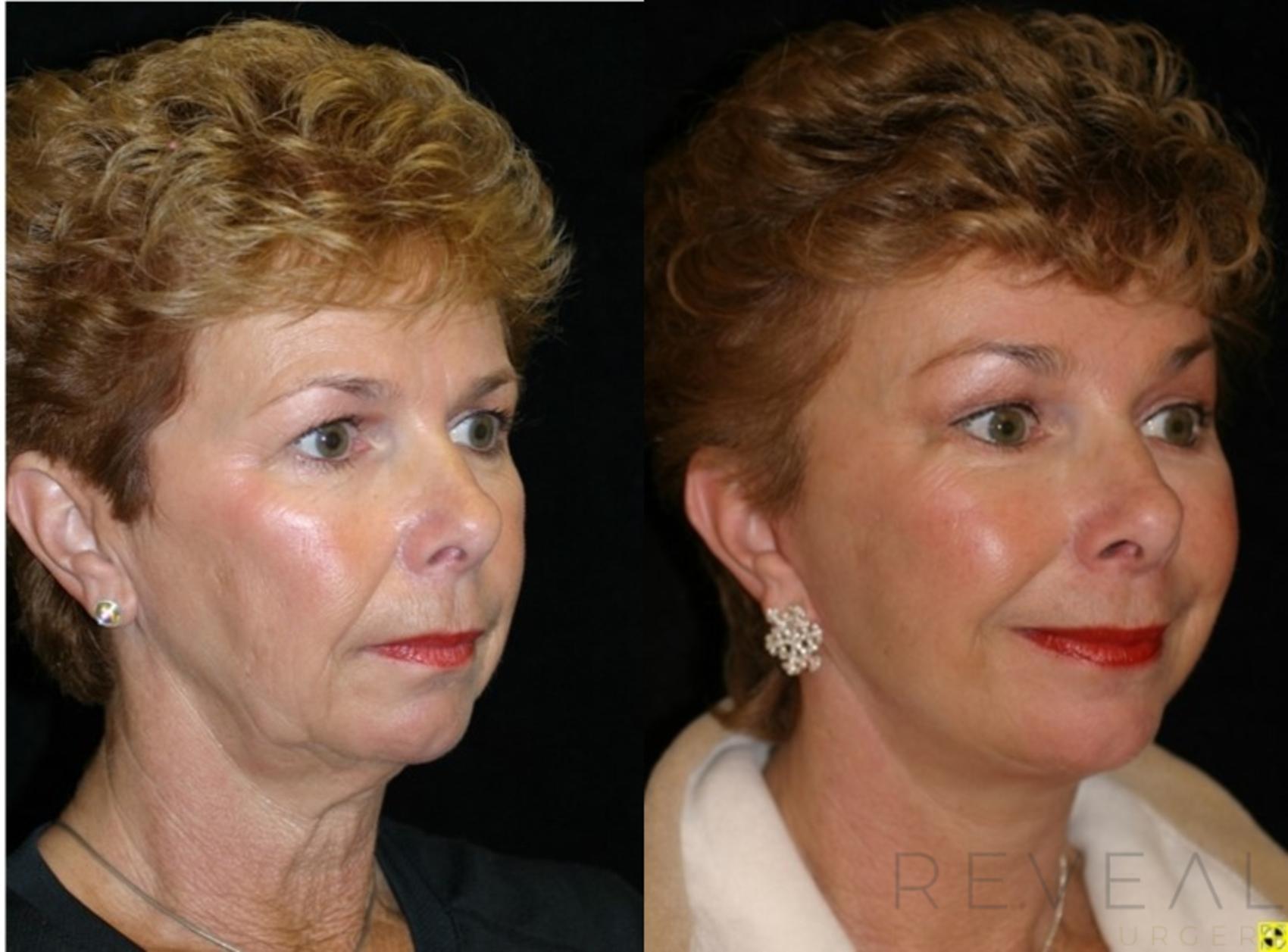 Before & After Facelift Case 420 View #1 View in San Jose, CA