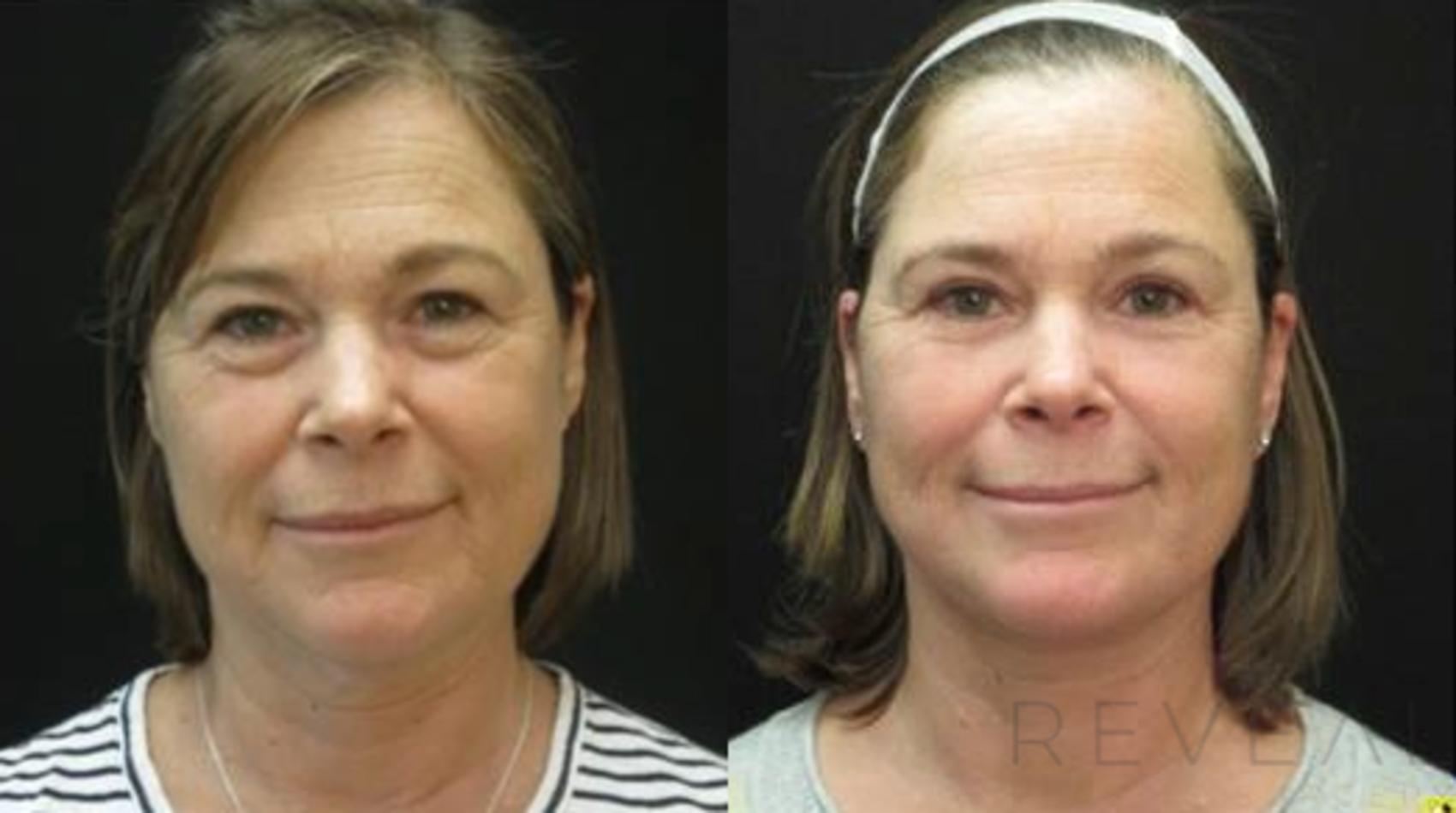 Before & After Eyelid Surgery Case 474 View #1 View in San Jose, CA