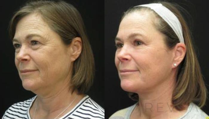 Before & After Facelift Case 474 View #3 View in San Jose, CA