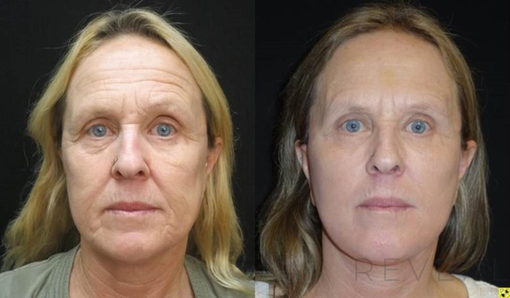 Before & After Fat Transfer to Face Case 479 View #1 View in San Jose, CA