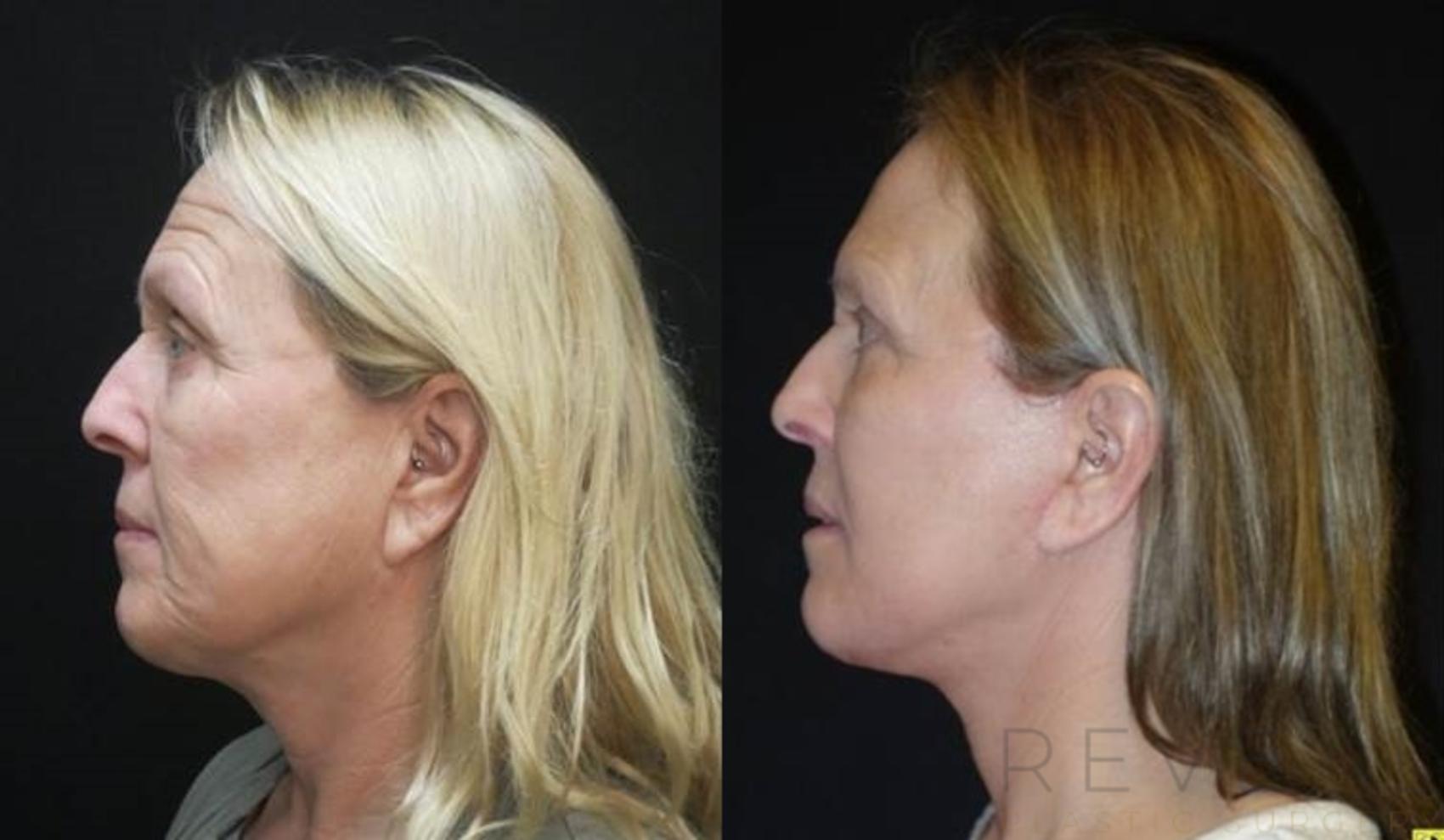 Before & After Facelift Case 479 View #2 View in San Jose, CA