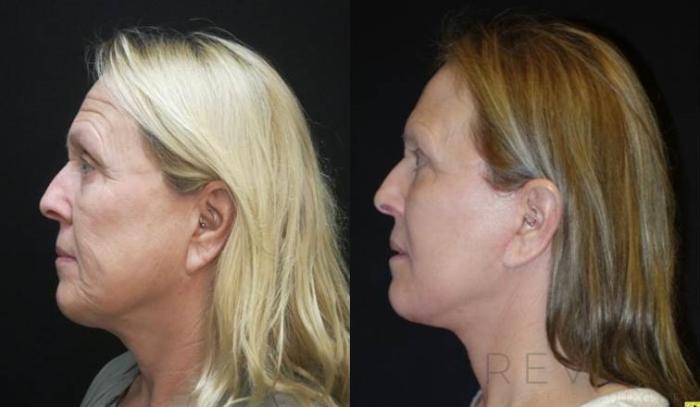 Before & After Fat Transfer to Face Case 479 View #2 View in San Jose, CA