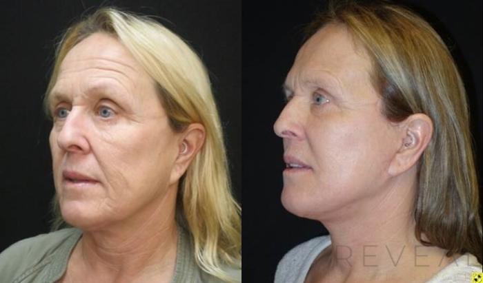 Before & After Fat Transfer to Face Case 479 View #3 View in San Jose, CA