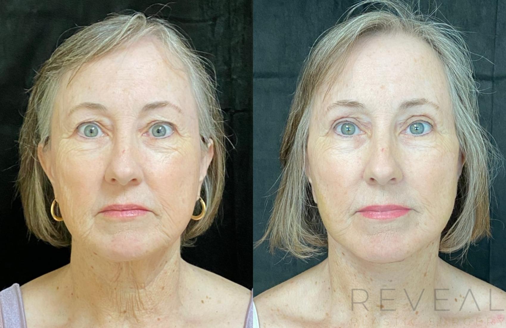 Before & After Eyelid Surgery Case 512 View #1 View in San Jose, CA