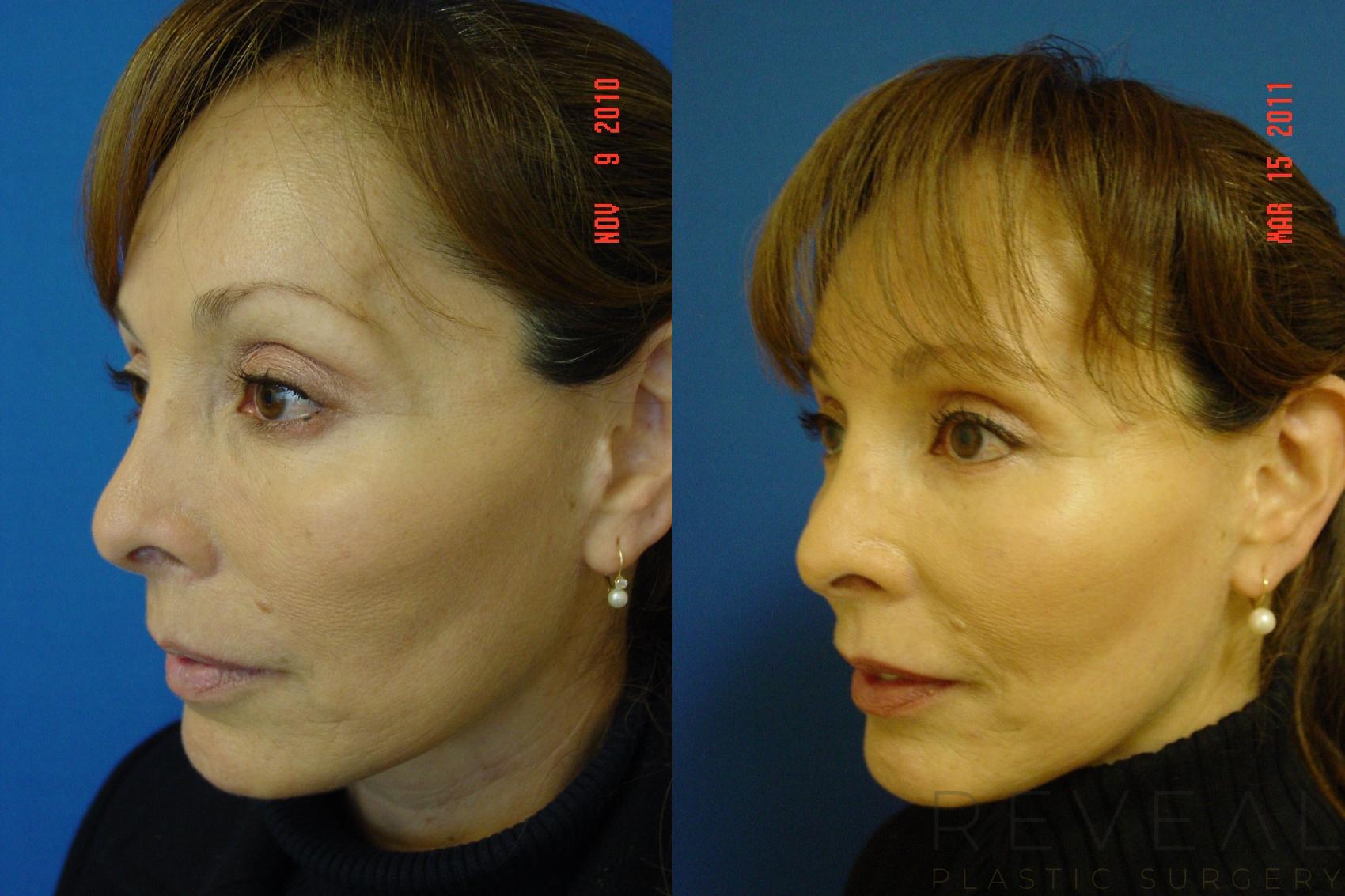 Before & After BOTOX® Cosmetic Case 54 View #1 View in San Jose, CA