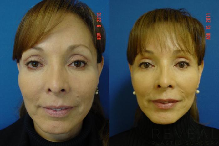 Before & After Eyelid Surgery Case 54 View #2 View in San Jose, CA