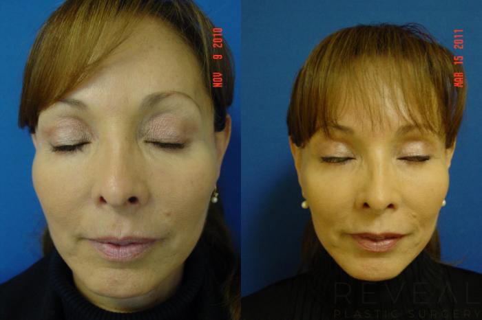 Before & After Eyelid Surgery Case 54 View #3 View in San Jose, CA