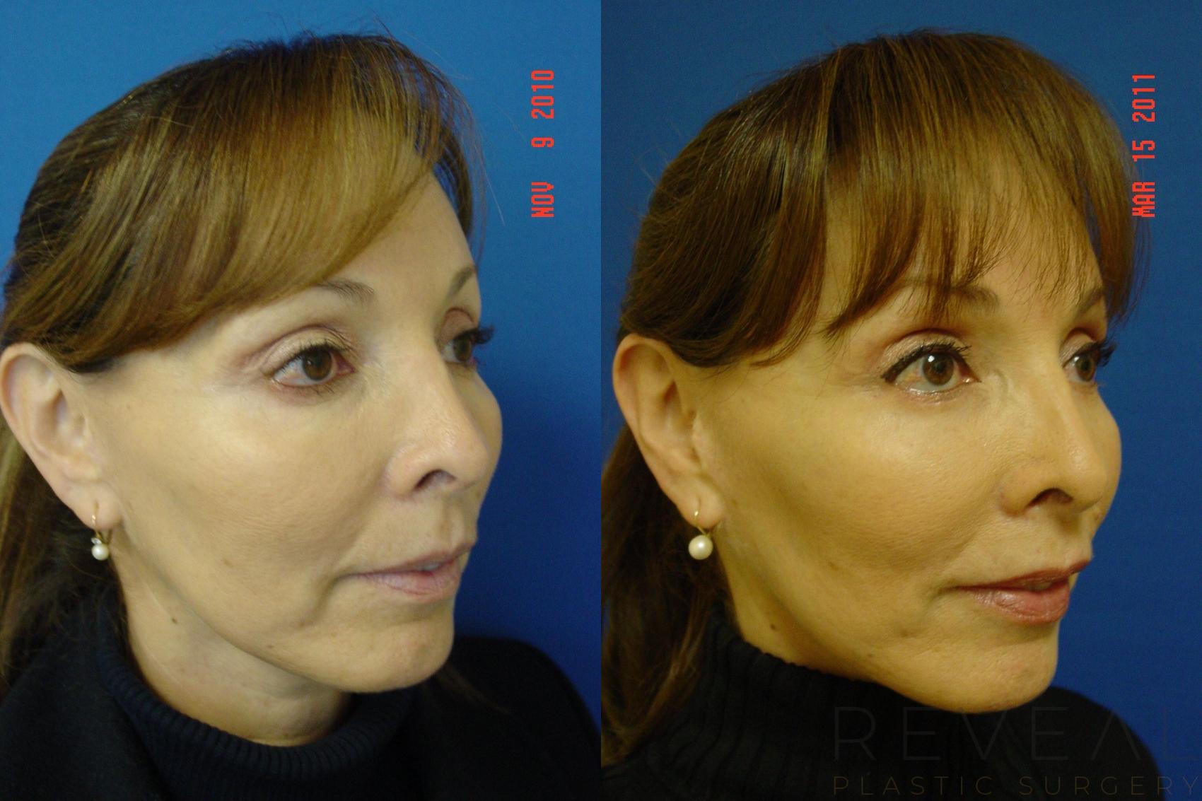 Before & After Facelift Case 54 View #4 View in San Jose, CA