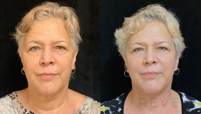 Before & After Neck Lift Case 580 View #1 View in San Jose, CA