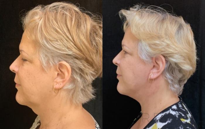 Before & After Neck Lift Case 580 View #2 View in San Jose, CA