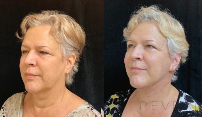 Before & After Neck Lift Case 580 View #3 View in San Jose, CA