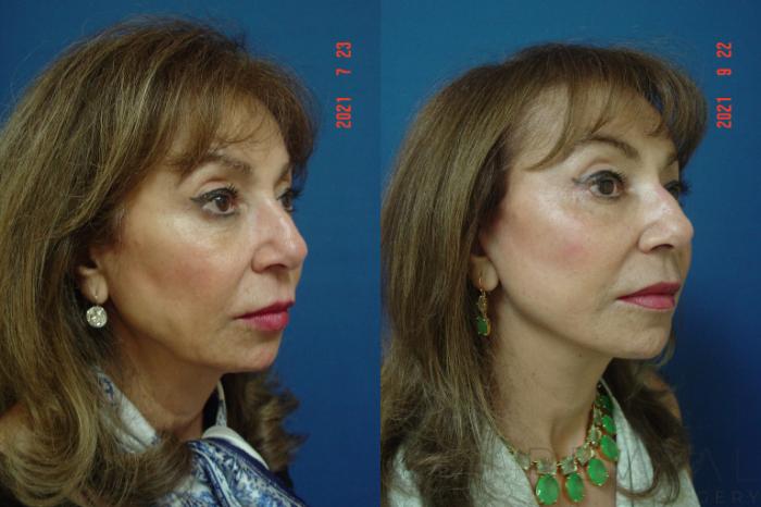 Before & After Eyelid Surgery Case 587 View #2 View in San Jose, CA
