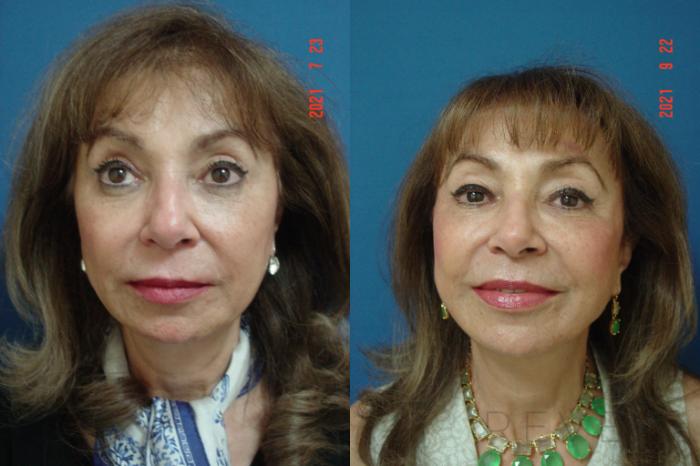 Before & After Facelift Case 587 View #3 View in San Jose, CA