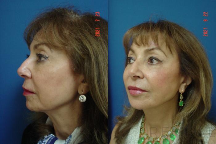 Before & After Neck Lift Case 587 View #4 View in San Jose, CA