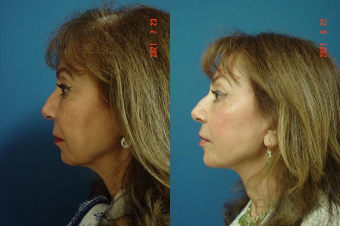 Before & After Eyelid Surgery Case 587 View #5 View in San Jose, CA