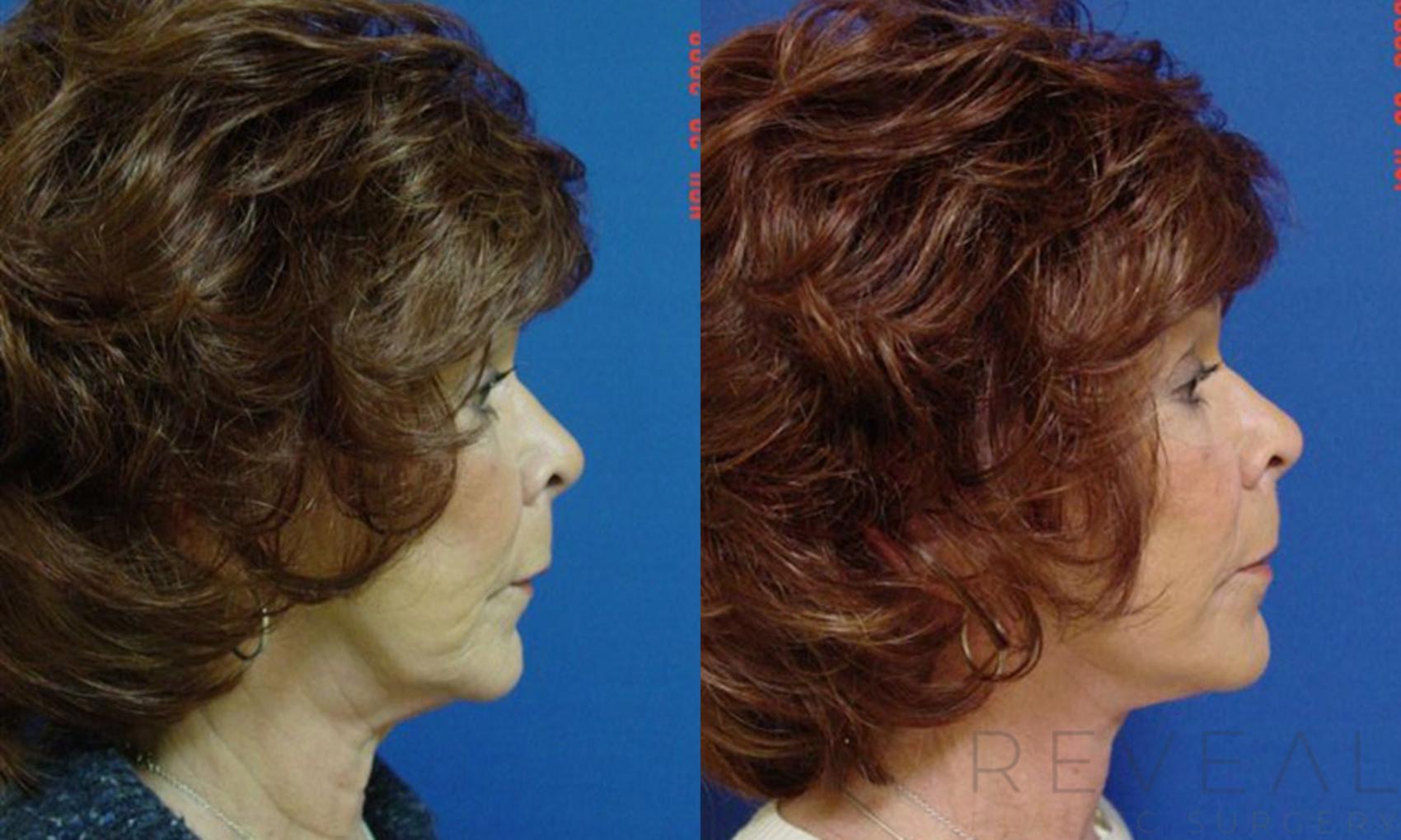 Before & After Facelift Case 6 View #3 View in San Jose, CA