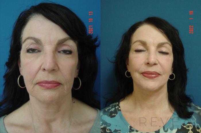 Before & After Eyelid Surgery Case 612 Front View in San Jose, CA