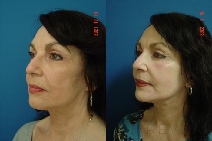 Before & After Facelift Case 612 Left Oblique View in San Jose, CA