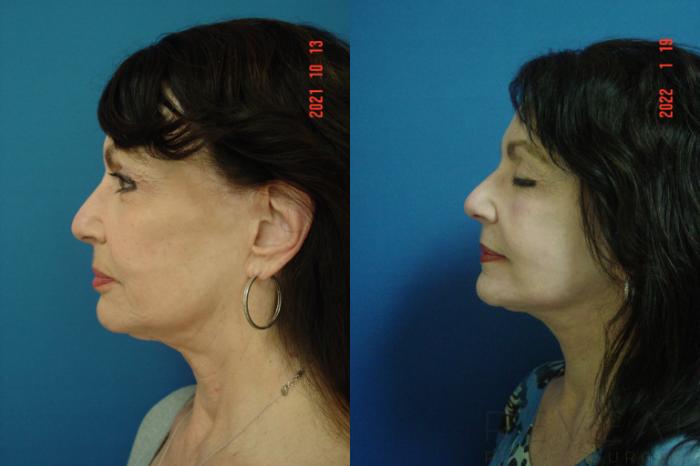 Before & After Facelift Case 612 Left Side View in San Jose, CA