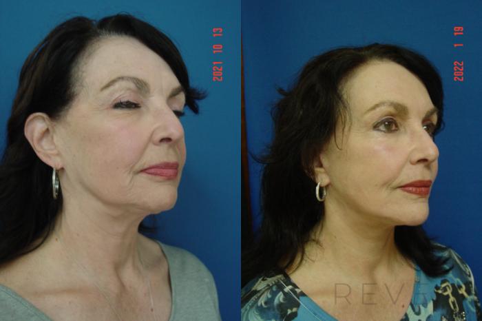 Before & After Facelift Case 612 Right Oblique View in San Jose, CA