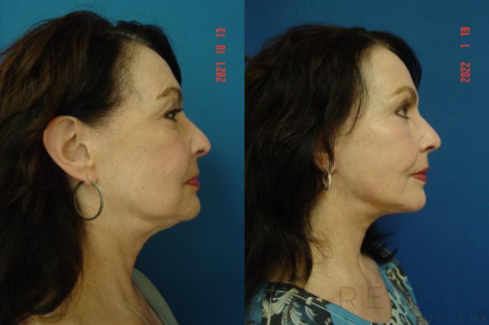 Before & After Facelift Case 612 Right Side View in San Jose, CA