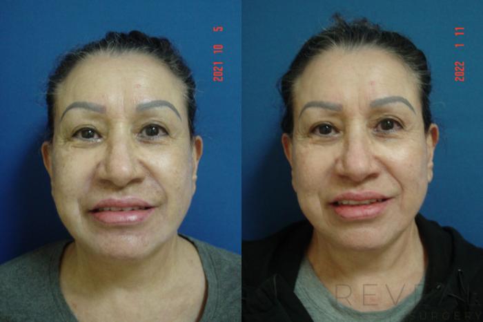 Before & After Fat Transfer to Face Case 613 Front View in San Jose, CA