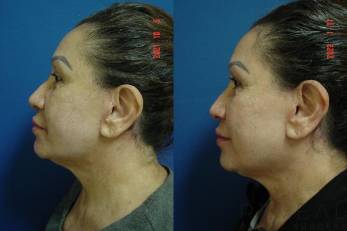 Before & After Facelift Case 613 Left Oblique View in San Jose, CA
