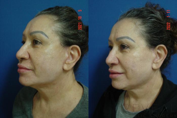 Before & After Fat Transfer to Face Case 613 Left Side View in San Jose, CA