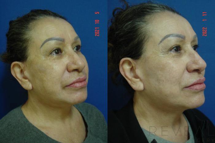 Before & After Fat Transfer to Face Case 613 Right Oblique View in San Jose, CA