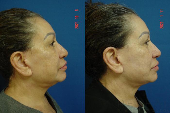 Before & After Fat Transfer to Face Case 613 Right Side View in San Jose, CA