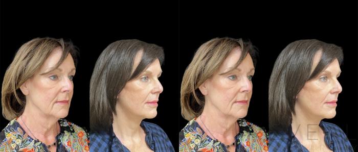 Before & After Facelift Case 618 Right Oblique View in San Jose, CA