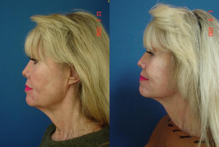 Before & After Facelift Case 636 Left Oblique View in San Jose, CA