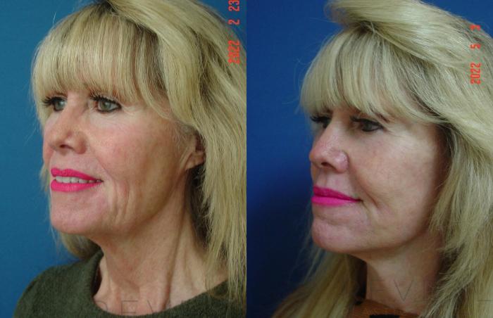 Before & After Eyelid Surgery Case 636 Left Side View in San Jose, CA
