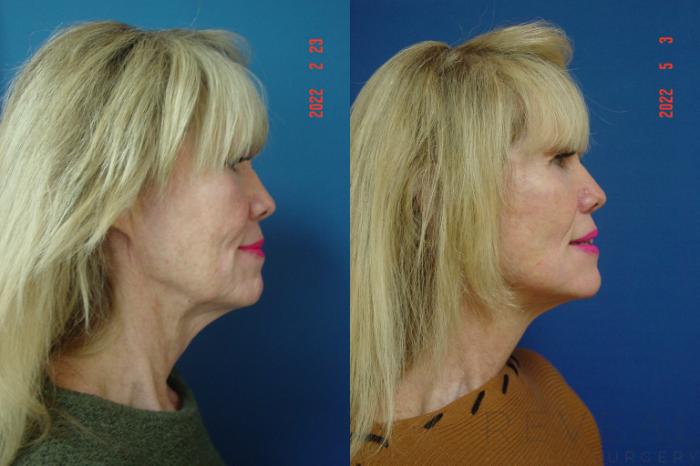 Before & After Facelift Case 636 Right Oblique View in San Jose, CA