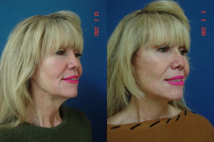 Before & After Neck Lift Case 636 Right Side View in San Jose, CA