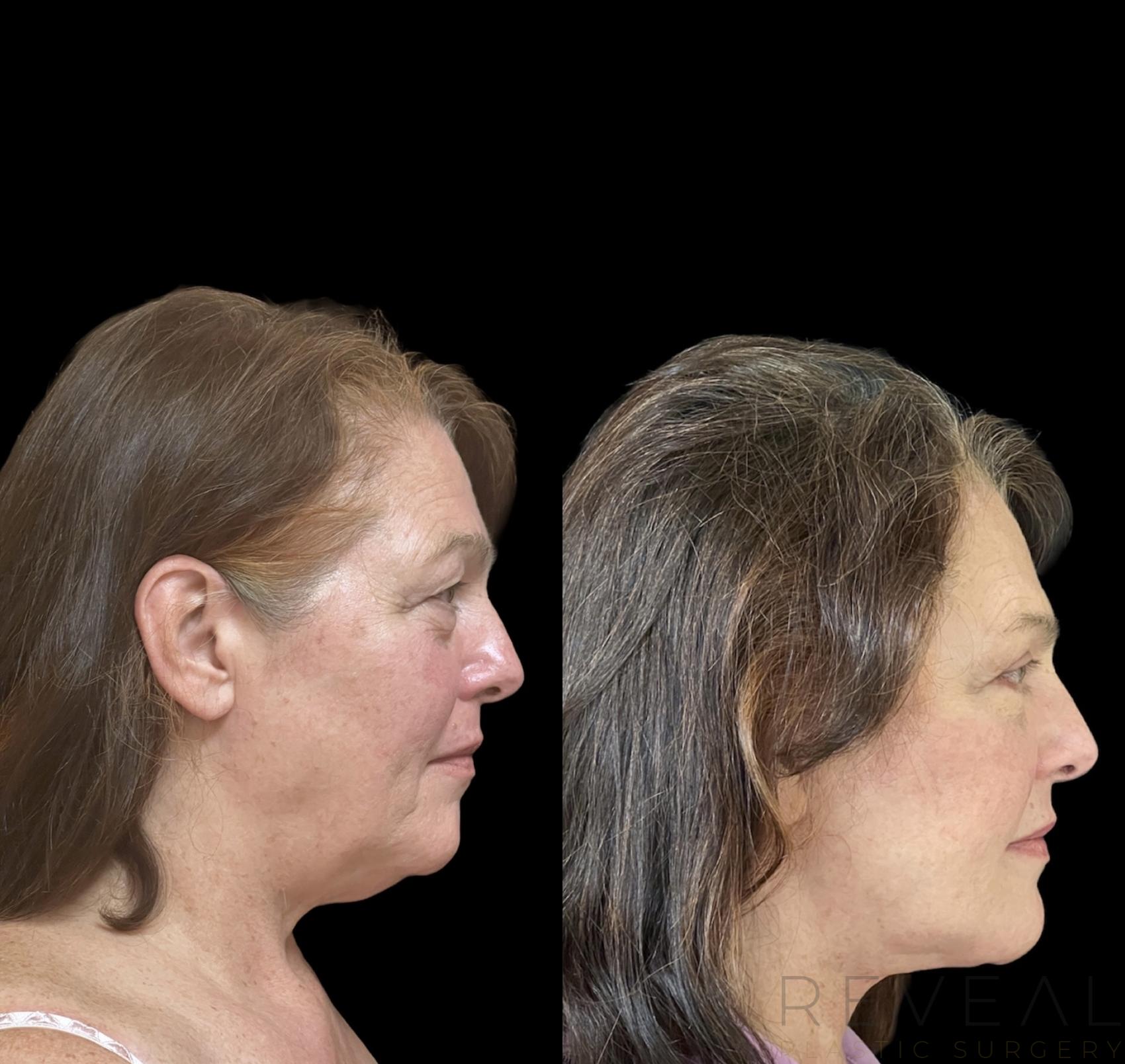 Before & After Facelift Case 646 Left Side View in San Jose, CA