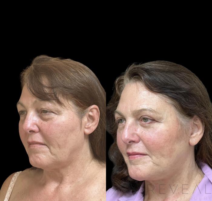 Before & After Facelift Case 646 Right Side View in San Jose, CA