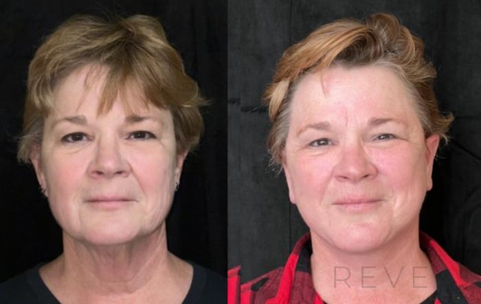 Before & After Neck Lift Case 671 Front View in San Jose, CA