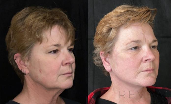 Before & After Facelift Case 671 Left Oblique View in San Jose, CA