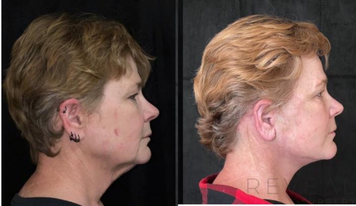 Before & After Facelift Case 671 Left Side View in San Jose, CA