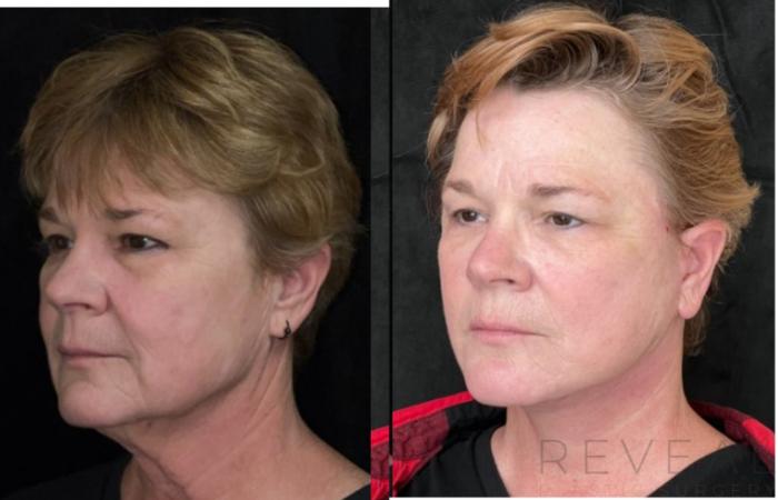 Before & After Neck Lift Case 671 Right Side View in San Jose, CA