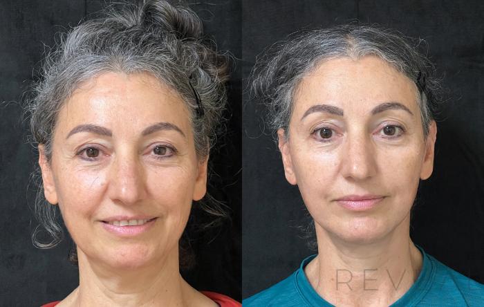 Before & After Neck Lift Case 676 Front View in San Jose, CA