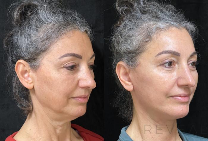 Before & After Neck Lift Case 676 Left Oblique View in San Jose, CA