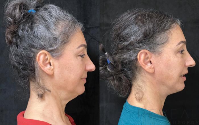 Before & After Neck Lift Case 676 Left Side View in San Jose, CA