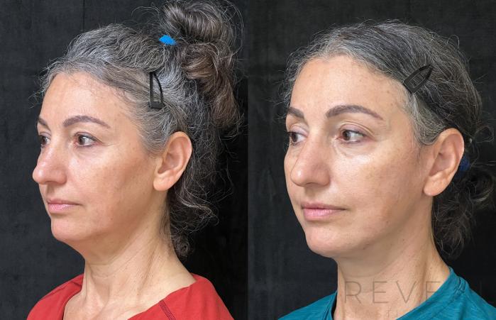 Before & After Facelift Case 676 Right Oblique View in San Jose, CA